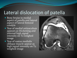 Lateral dislocation of patella
 Bony bruise in medial
aspect of patella and lateral
aspect of lateral femoral
condyle
 Tear of medial retinaculum
appears as thickening and
internal high signal
intensity on T2 weighed
image
 Tear of vastus medialis
oblique muscle appear as
high signal intensity on T2
weighed image
 