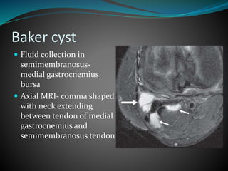 Baker cyst
 Fluid collection in
semimembranosus-
medial gastrocnemius
bursa
 Axial MRI- comma shaped
with neck extending
between tendon of medial
gastrocnemius and
semimembranosus tendon
 