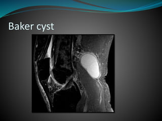 Baker cyst
 