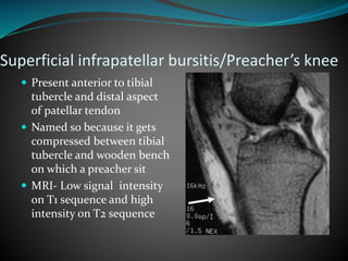 Superficial infrapatellar bursitis/Preacher’s knee
 Present anterior to tibial
tubercle and distal aspect
of patellar tendon
 Named so because it gets
compressed between tibial
tubercle and wooden bench
on which a preacher sit
 MRI- Low signal intensity
on T1 sequence and high
intensity on T2 sequence
 
