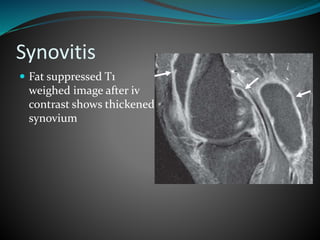 Synovitis
 Fat suppressed T1
weighed image after iv
contrast shows thickened
synovium
 