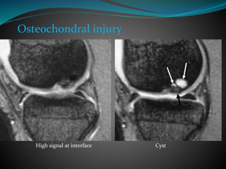 High signal at interface Cyst
Osteochondral injury
 