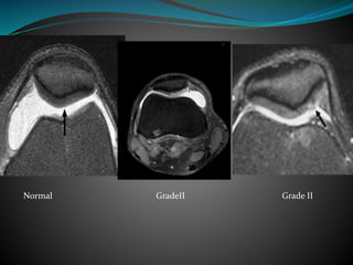 Normal GradeII Grade II
 