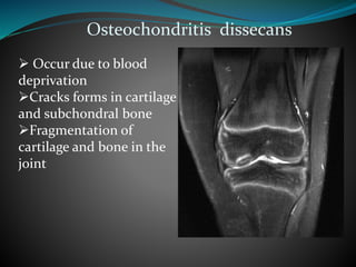 Osteochondritis dissecans
 Occur due to blood
deprivation
Cracks forms in cartilage
and subchondral bone
Fragmentation of
cartilage and bone in the
joint
 