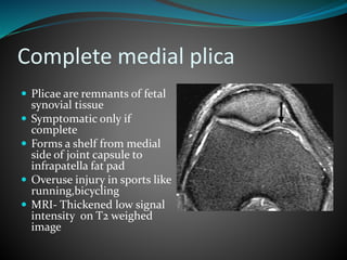 Complete medial plica
 Plicae are remnants of fetal
synovial tissue
 Symptomatic only if
complete
 Forms a shelf from medial
side of joint capsule to
infrapatella fat pad
 Overuse injury in sports like
running,bicycling
 MRI- Thickened low signal
intensity on T2 weighed
image
 