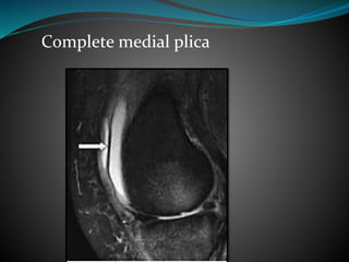 Complete medial plica
 