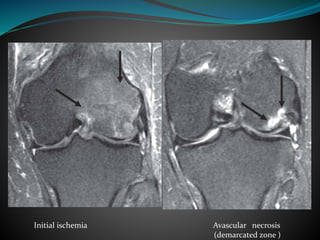 Initial ischemia Avascular necrosis
(demarcated zone )
 