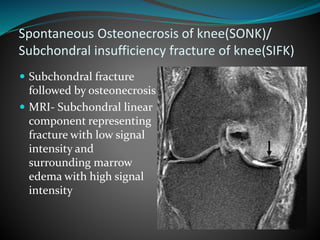 Spontaneous Osteonecrosis of knee(SONK)/
Subchondral insufficiency fracture of knee(SIFK)
 Subchondral fracture
followed by osteonecrosis
 MRI- Subchondral linear
component representing
fracture with low signal
intensity and
surrounding marrow
edema with high signal
intensity
 