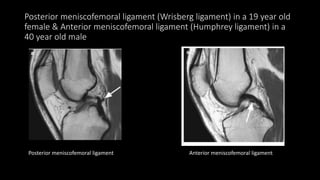 Wrisberg Rip Mri MRI OF KNEE JOINT.pptx