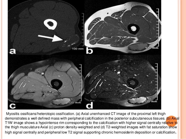 Mri of muscle diseases