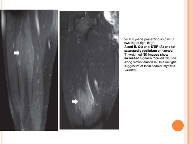 Mri of muscle diseases
