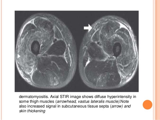 Mri of muscle diseases
