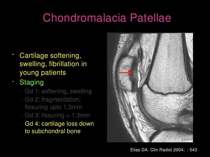 MRI of patellar disorders