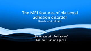 Dr. Hazem Abu Zeid Yousef
Ass. Prof. Radiodiagnosis.
The MRI features of placental
adhesion disorder
Pearls and pitfalls
 