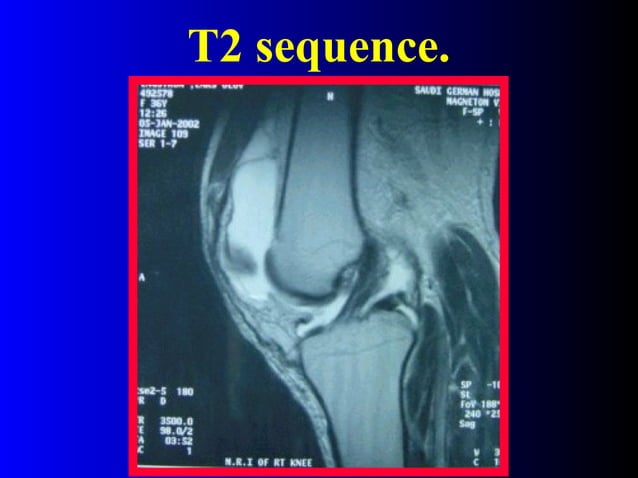mri-of-the-knee-ppt