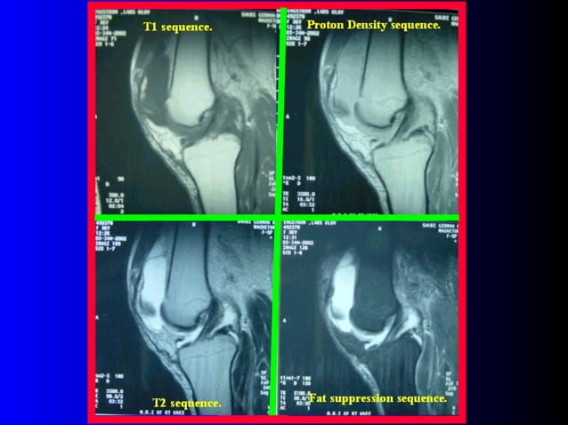mri-of-the-knee-ppt