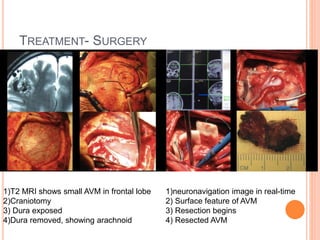 TREATMENT- SURGERY
1)T2 MRI shows small AVM in frontal lobe
2)Craniotomy
3) Dura exposed
4)Dura removed, showing arachnoid
1)neuronavigation image in real-time
2) Surface feature of AVM
3) Resection begins
4) Resected AVM
 