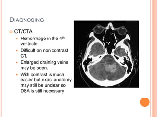 DIAGNOSING
 CT/CTA
 Hemorrhage in the 4th
ventricle
 Difficult on non contrast
CT.
 Enlarged draining veins
may be seen.
 With contrast is much
easier but exact anatomy
may still be unclear so
DSA is still necessary
 