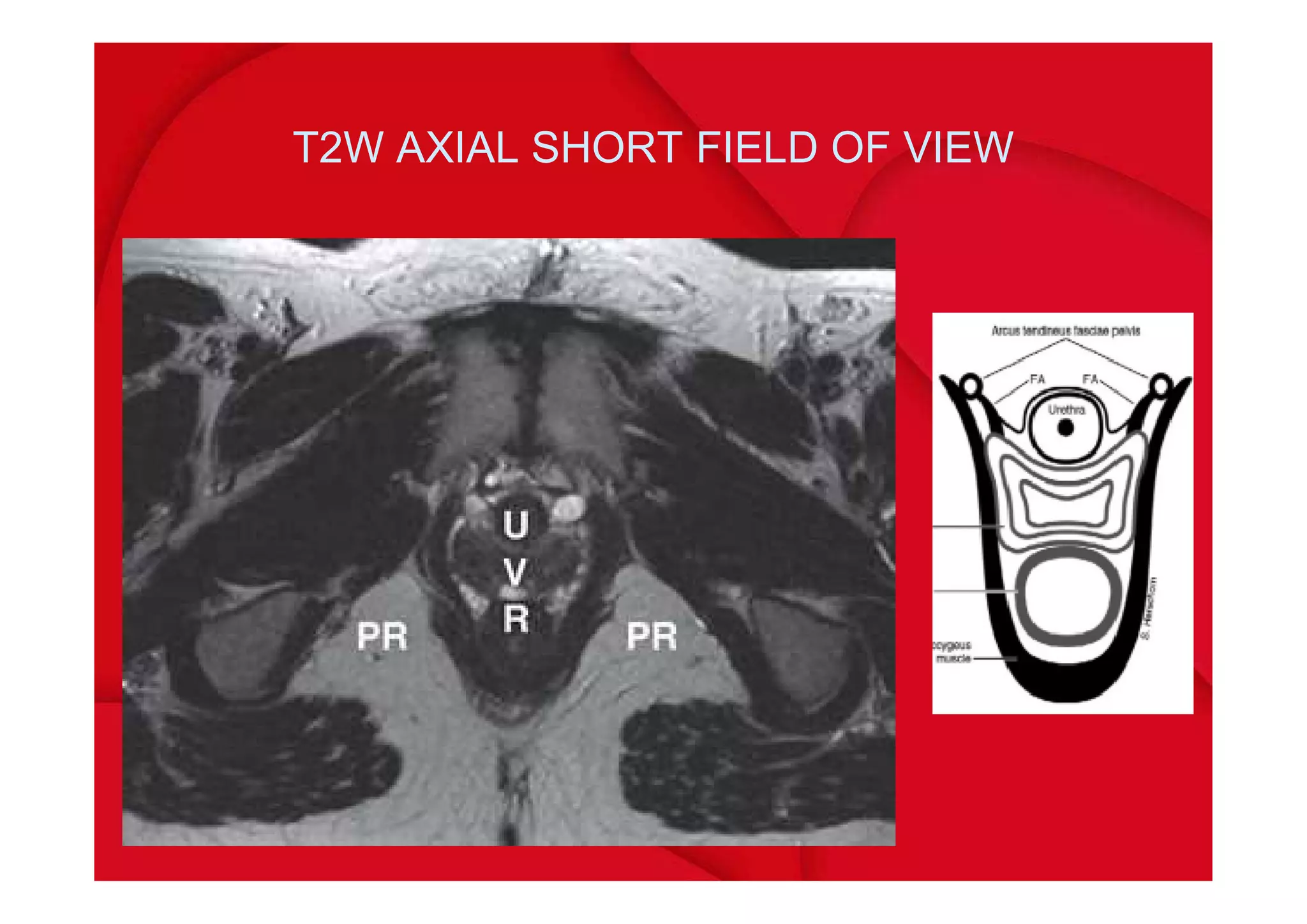 Mri pelvic floor | PDF