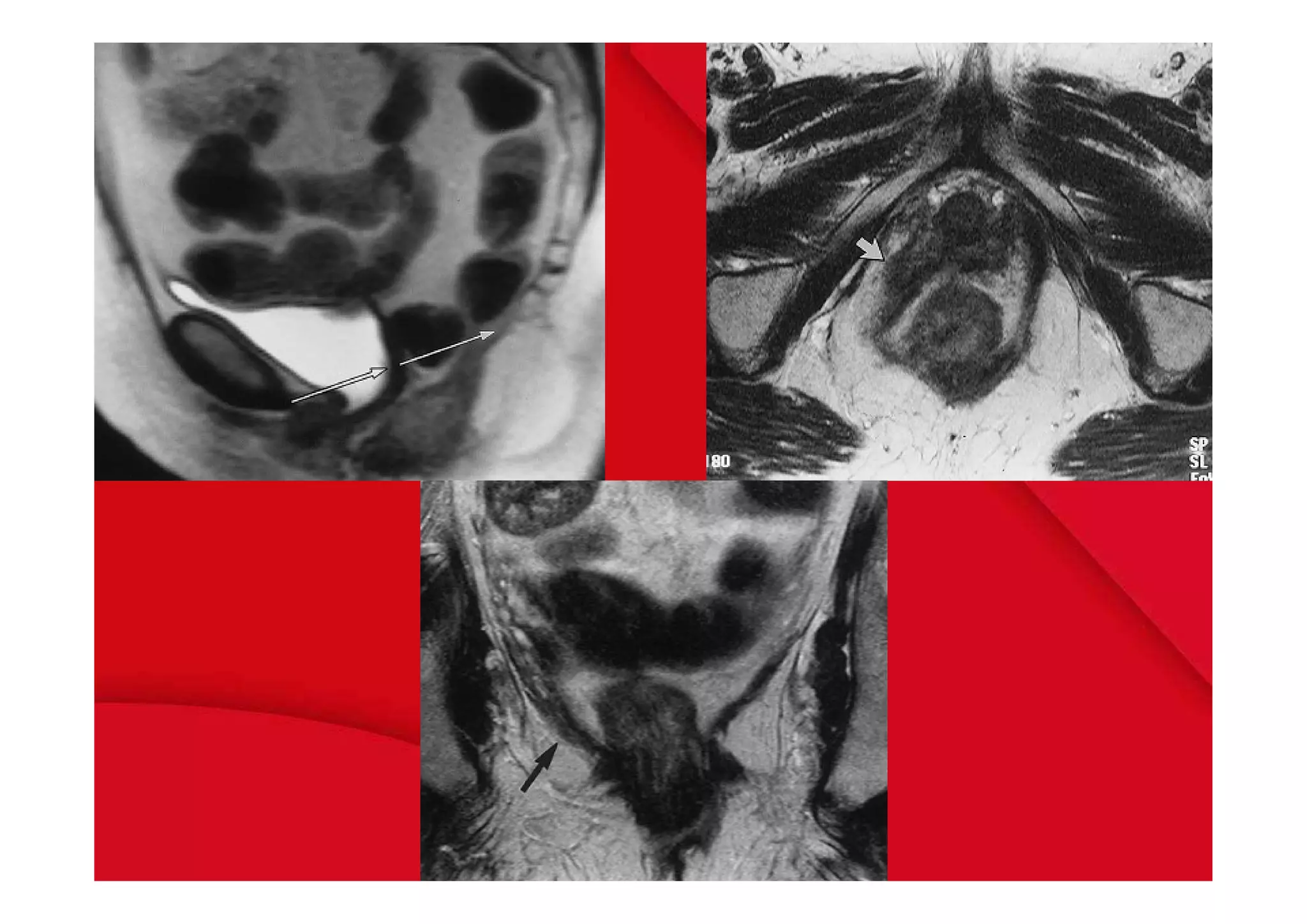 Mri pelvic floor | PDF