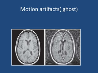 Motion artifacts( ghost)

 