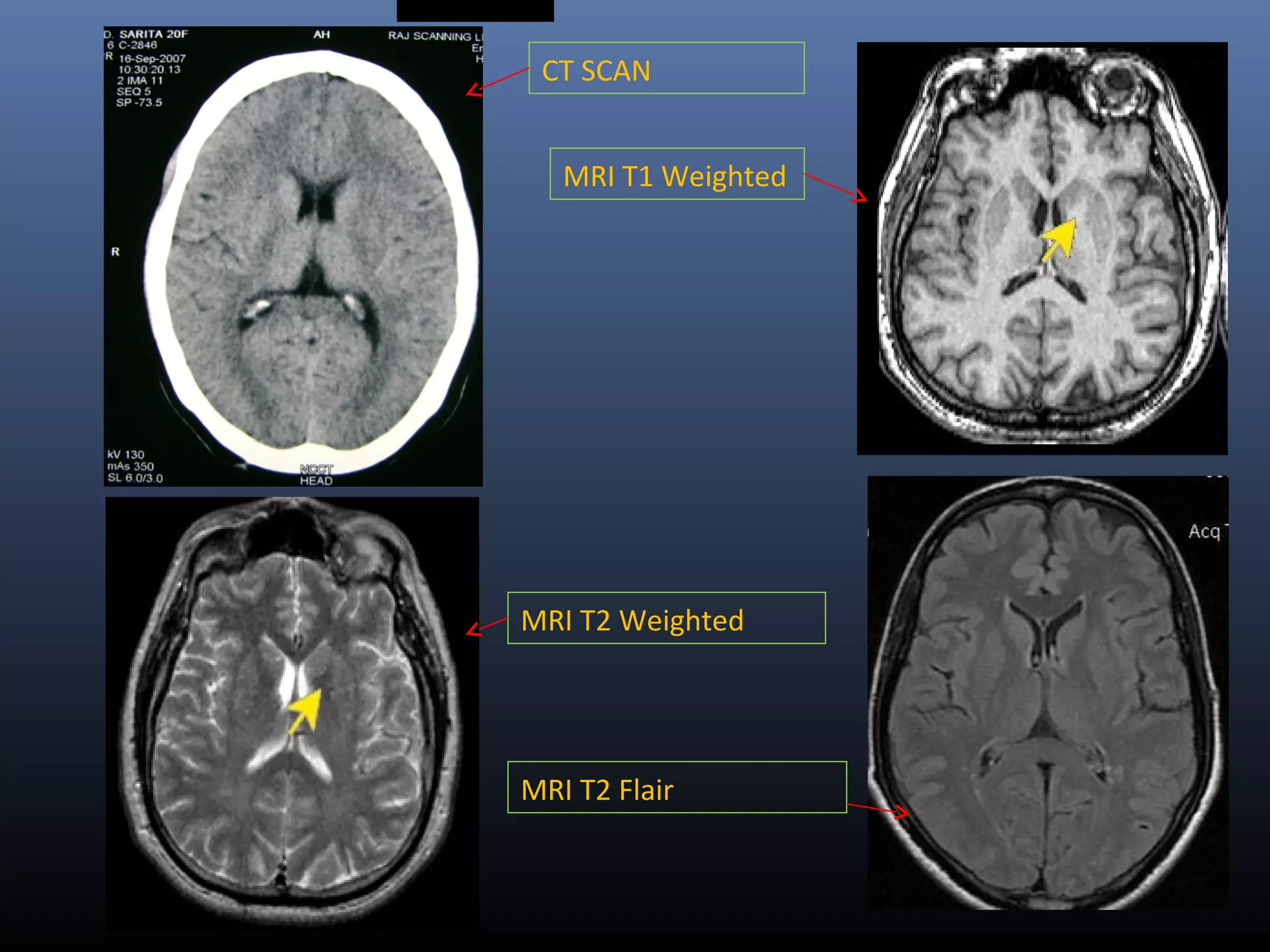 CT SCAN
MRI T1 Weighted
MRI T2 Weighted
MRI T2 Flair
 