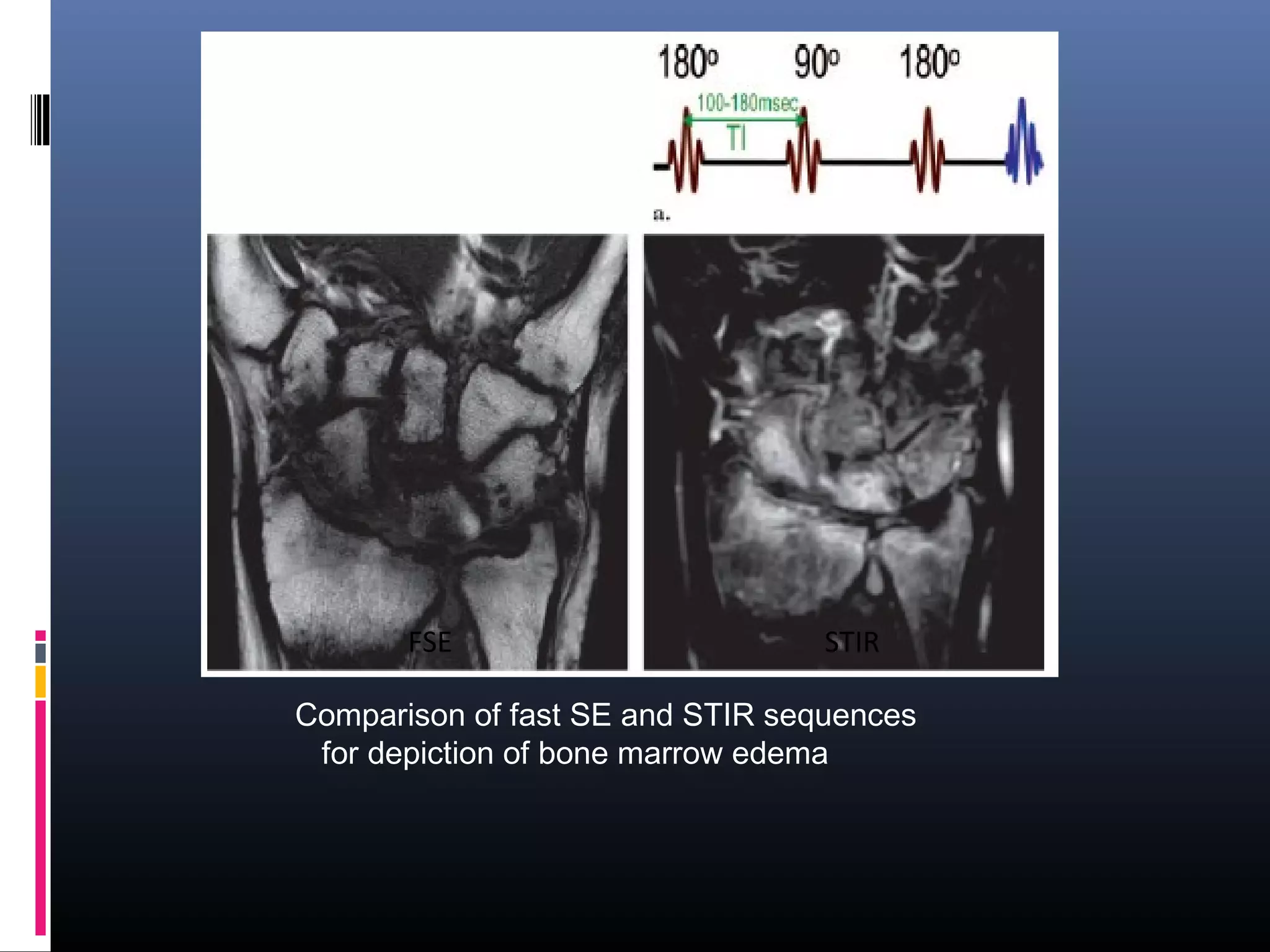 Comparison of fast SE and STIR sequences
for depiction of bone marrow edema
FSE STIR
 