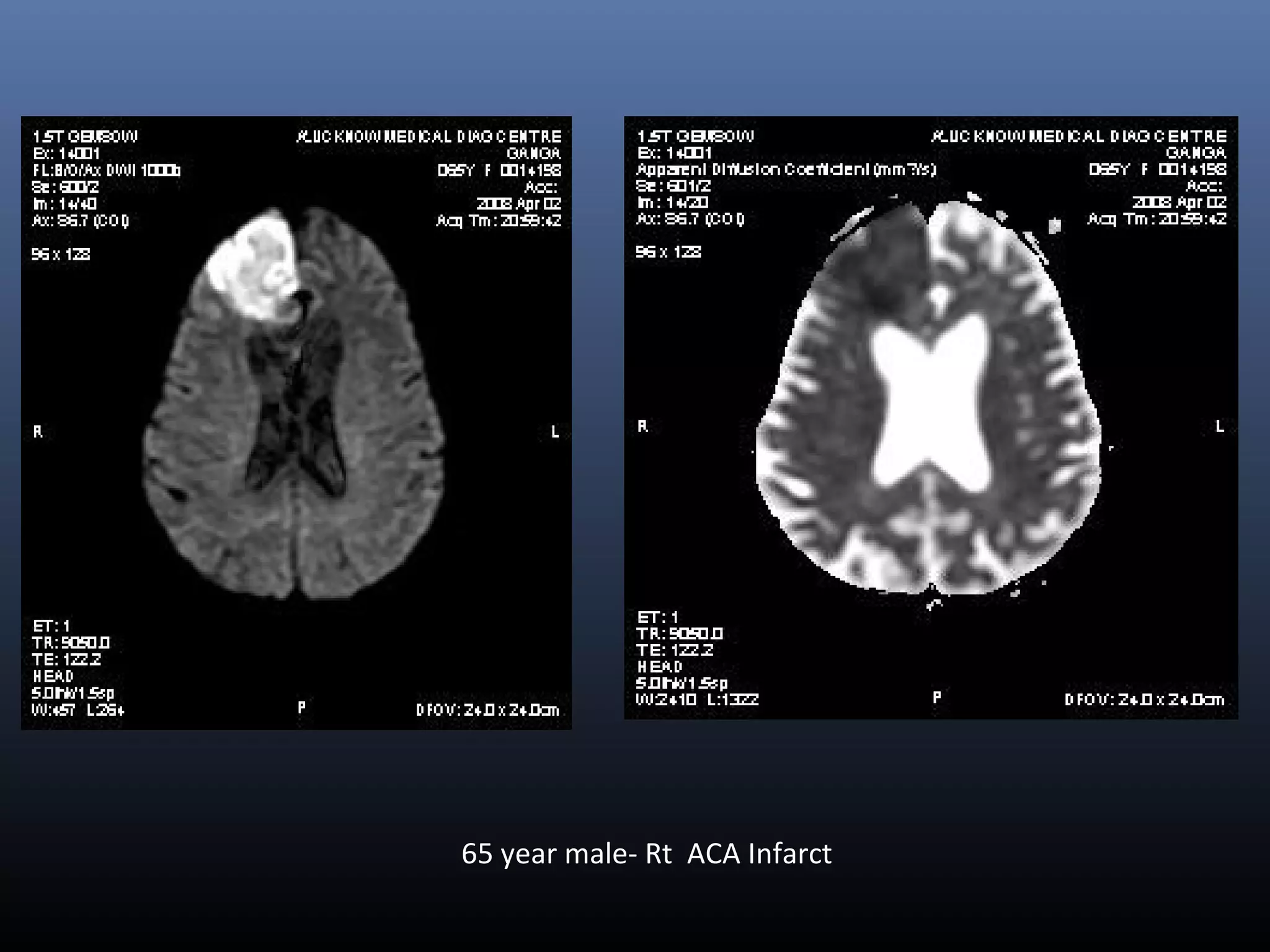 65 year male- Rt ACA Infarct
 