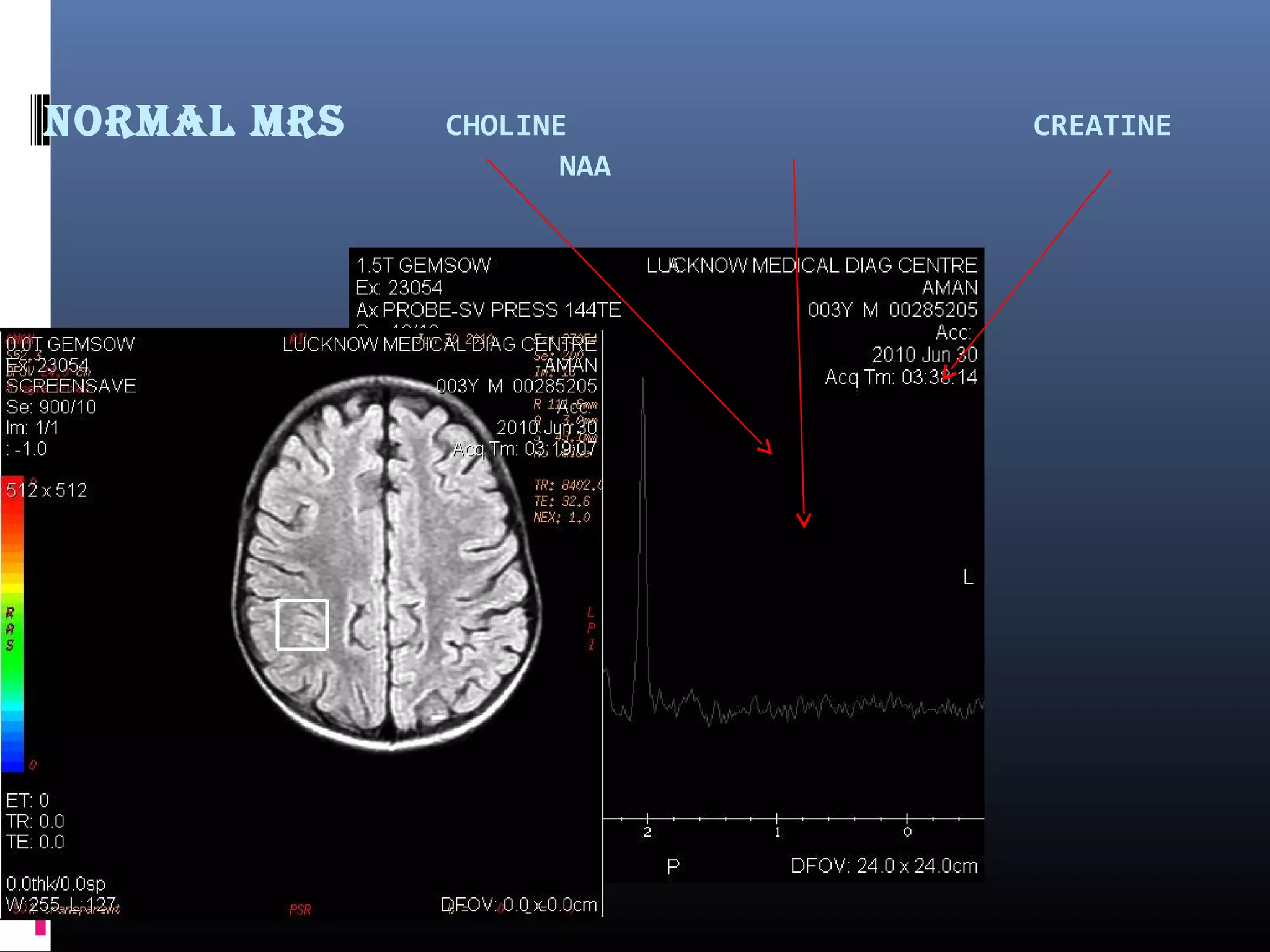 Normal mrS CHOLINE CREATINE
NAA
 