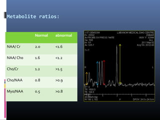 Metabolite ratios:
Normal abnormal
NAA/ Cr 2.0 <1.6
NAA/ Cho 1.6 <1.2
Cho/Cr 1.2 >1.5
Cho/NAA 0.8 >0.9
Myo/NAA 0.5 >0.8
 