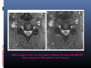 GRE images of the cervical spine without (A) and with (B) MT
show improved CSF–spinal cord contrast
 