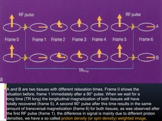 A and B are two tissues with different relaxation times. Frame 0 shows the
situation before, frame 1 immediately after a 90° pulse. When we wait for a
long time (TR long) the longitudinal magnetization of both tissues will have
totally recovered (frame 5). A second 90° pulse after this time results in the same
amount of transversal magnetization (frame 6) for both tissues, as was observed after
the first RF pulse (frame 1). the difference in signal is mainly due to different proton
densities, we have a so called proton density (or spin density) weighted image.
 