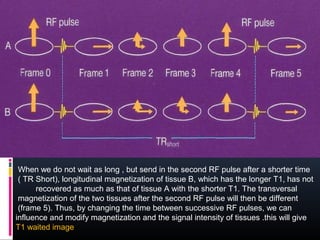 When we do not wait as long , but send in the second RF pulse after a shorter time
( TR Short), longitudinal magnetization of tissue B, which has the longer T1, has not
recovered as much as that of tissue A with the shorter T1. The transversal
magnetization of the two tissues after the second RF pulse will then be different
(frame 5). Thus, by changing the time between successive RF pulses, we can
influence and modify magnetization and the signal intensity of tissues .this will give
T1 waited image
 