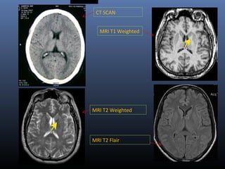CT SCAN
MRI T1 Weighted
MRI T2 Weighted
MRI T2 Flair
 