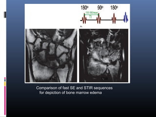 Comparison of fast SE and STIR sequences
for depiction of bone marrow edema
FSE STIR
 