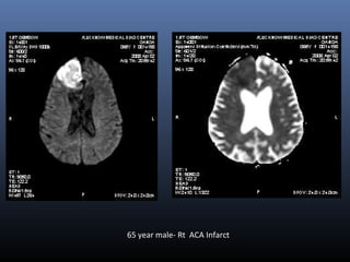 65 year male- Rt ACA Infarct
 