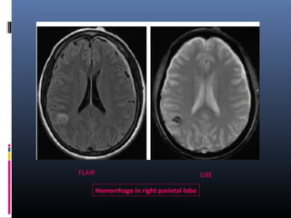 GREFLAIR
Hemorrhage in right parietal lobe
 