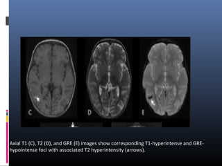 Axial T1 (C), T2 (D), and GRE (E) images show corresponding T1-hyperintense and GRE-
hypointense foci with associated T2 hyperintensity (arrows).
 