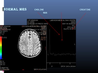 Normal mrS CHOLINE CREATINE
NAA
 