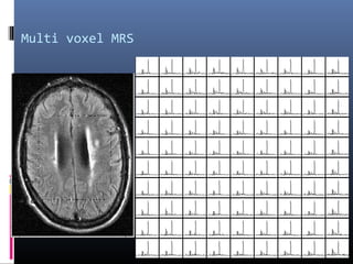 Multi voxel MRS
 