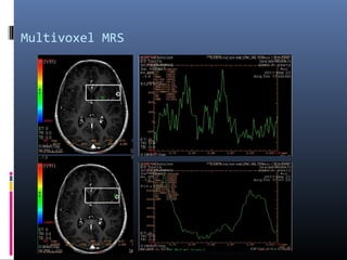 Multivoxel MRS
 
