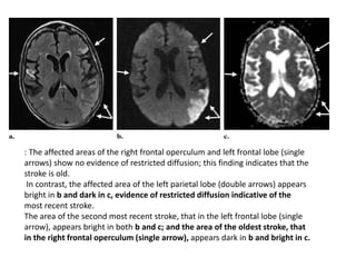 : The affected areas of the right frontal operculum and left frontal lobe (single
arrows) show no evidence of restricted diffusion; this finding indicates that the
stroke is old.
In contrast, the affected area of the left parietal lobe (double arrows) appears
bright in b and dark in c, evidence of restricted diffusion indicative of the
most recent stroke.
The area of the second most recent stroke, that in the left frontal lobe (single
arrow), appears bright in both b and c; and the area of the oldest stroke, that
in the right frontal operculum (single arrow), appears dark in b and bright in c.
 