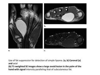 Use of fat suppression for detection of simple lipoma. (a, b) Coronal (a)
and axial
(b) T1-weighted SE images show a large ovoid lesion in the palm of the
hand with signal intensity paralleling that of subcutaneous fat.
 