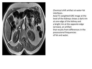Chemical shift artifact at water-fat
interfaces.
Axial T1-weighted GRE image at the
level of the kidneys shows a dark rim
at one edge of the kidney and
a bright rim at the opposite edge
(arrows), an artifact
that results from differences in the
precessional frequencies
of fat and water.
 