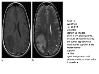 Axial T1-
Weighted
(a) and T2-
weighted
(b) fast SE images
show a low-grade glioma.
Because of hypercellularity,
the tumor appears with
hypointense signal in a and
hyperintense
signal in
b. The
cystic components and
edema are better depicted in
b than in a.
 