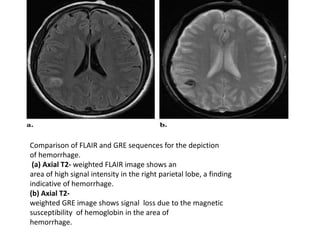 Comparison of FLAIR and GRE sequences for the depiction
of hemorrhage.
(a) Axial T2- weighted FLAIR image shows an
area of high signal intensity in the right parietal lobe, a finding
indicative of hemorrhage.
(b) Axial T2-
weighted GRE image shows signal loss due to the magnetic
susceptibility of hemoglobin in the area of
hemorrhage.
 