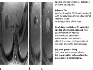 Spoiled GRE sequences for detection
of liver hemangioma.
(a) Axial T1-
weighted spoiled GRE image obtained
with fat saturation shows a low-signal-
intensity lesion
in the right lobe of the liver
.
(b, c) Axial multiphase T1-weighted
spoiled GRE images obtained with
gadolinium show nodular
discontinuous peripheral
enhancement immediately
after intravenous contrast material
injection and in the arterial phase
(b), with gradual filling
over time in the venous phase
(c), features that help confirm the
presence of a hemangioma.
 