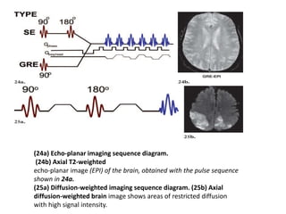 (24a) Echo-planar imaging sequence diagram.
(24b) Axial T2-weighted
echo-planar image (EPI) of the brain, obtained with the pulse sequence
shown in 24a.
(25a) Diffusion-weighted imaging sequence diagram. (25b) Axial
diffusion-weighted brain image shows areas of restricted diffusion
with high signal intensity.
 