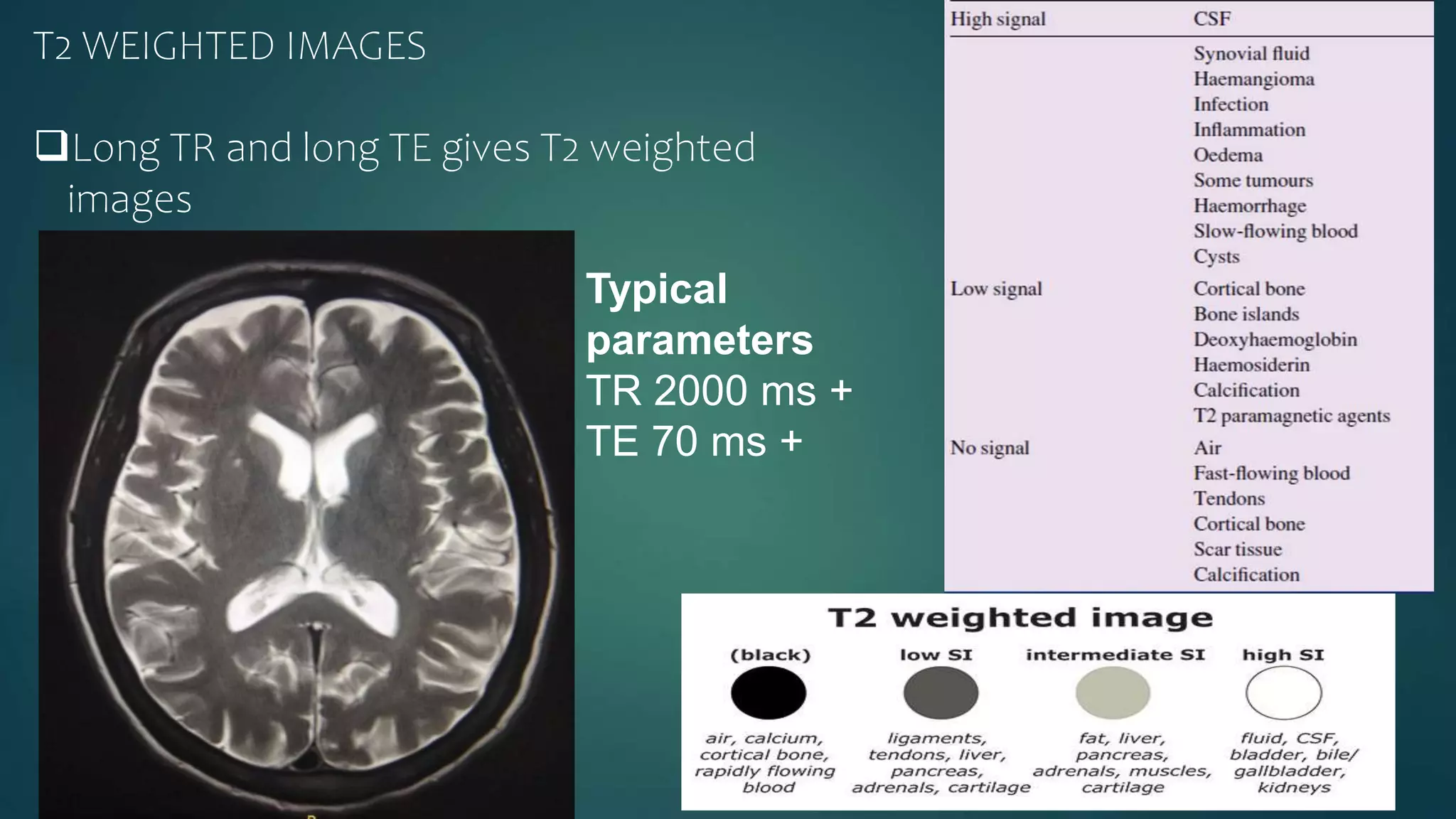 T2 WEIGHTED IMAGES
Long TR and long TE gives T2 weighted
images
Typical
parameters
TR 2000 ms +
TE 70 ms +
 