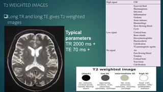 T2 WEIGHTED IMAGES
Long TR and long TE gives T2 weighted
images
Typical
parameters
TR 2000 ms +
TE 70 ms +
 